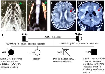 Case Report: Chronic inflammatory demyelinating polyradiculoneuropathy rather than hemophagocytic lymphohistiocytosis—the initial phenotype of PRF1 gene mutation